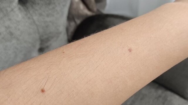 moles on the skin of a hand and arm, representing mole checking, skin examination, dermatology and monitoring of skin health.