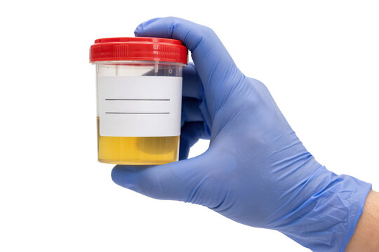Hand in a blue medical glove holding a plastic container with a yellow urine sample for clinical testing isolated on a transparent background