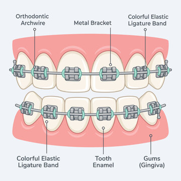Detailed medical illustration of dental braces with labeled anatomical parts including brackets, archwire, and gums
