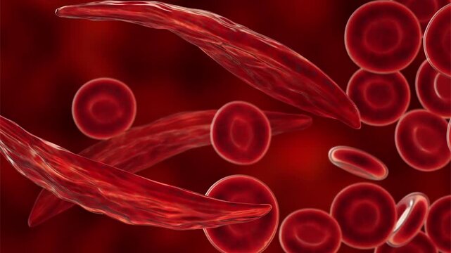 Sickle cell anaemia, 3D animation of sickle-shaped red blood cells among normal erythrocytes circulating in blood.