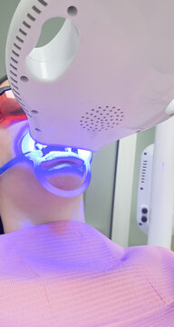 Teeth whitening procedure with blue LED light acceleration lamp, cheek retractor, and protective glasses in a dental clinic