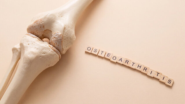 Osteoarthritis joint degeneration concept for bone health awareness and orthopedic medical diagnosis education