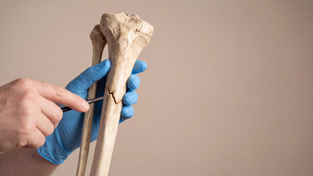 Bone fracture examination concept for orthopedic injury diagnosis and skeletal medical education