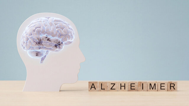 Alzheimer disease progressive memory loss concept for brain health awareness and neurological diagnosis education