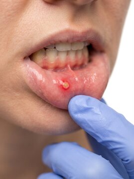 Close-up of a canker sore or aphthous ulcer on a patient's lower lip being examined by a medical professional in blue gloves