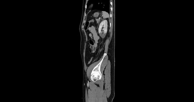 Grayscale sagittal CT scan zooms into the abdomen and spine showing the traumatic kidney injury. Left renal injury grade 4. Suggested left adrenal injury.