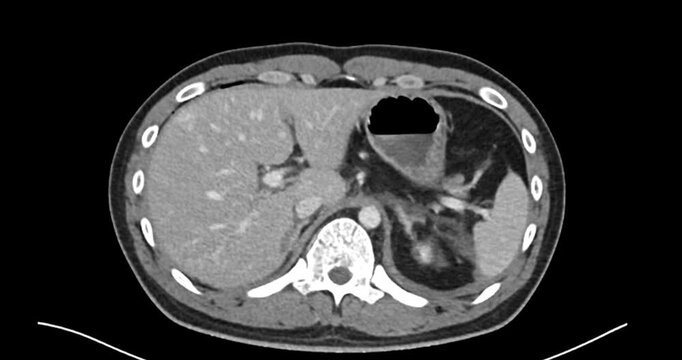 Axial CT scan scrolls from the upper abdomen to the pelvis. Left renal injury grade 4. Suggested left adrenal injury.
