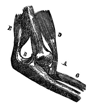 Vintage medical engraving of an elbow dislocation labeled