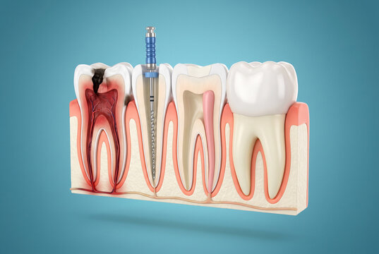 Endodontic Root Canal Treatment Stages Showing Infected Pulp Filing and Crown Restoration 3D Illustration for Dental Education