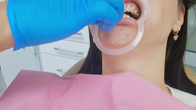 Dentist applying whitening gel or treatment to teeth with a cotton swab in a clinic