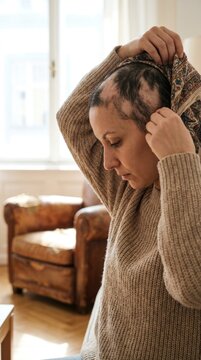 Autoimmune scalp disorder: alopecia areata, baldness pattern, female patient, tie kerchief, cover head, hair shedding, emotional acceptance, dermatology treatment.