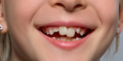 Joyful girl shows crooked teeth in bright studio crop with cheerful smile. Pediatric dentistry,...