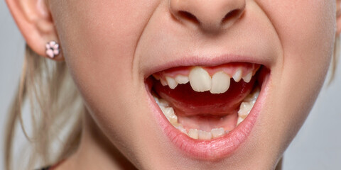 Playful child opens her mouth to show crooked teeth in bright studio with excited surprise....
