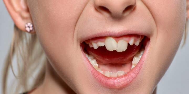Playful child opens her mouth to show crooked teeth in bright studio with excited surprise. Pediatric care, tooth development, orthodontics concept.