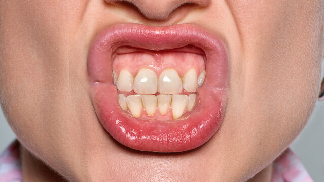 Expressive woman bares clenched teeth in clinical studio closeup with comic frustration. Bruxism, dental health, stress awareness concept.