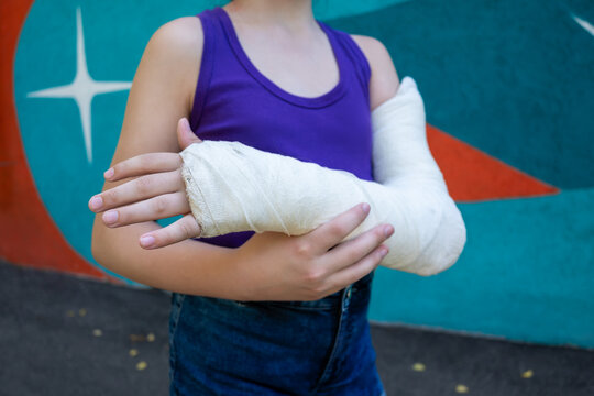 Unrecognizable girl with bone fracture in full arm cast on colored background. Immobilization of elbow joint with splint.