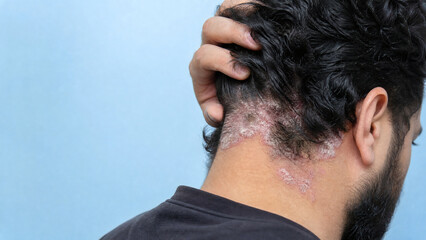 Fototapeta premium Scaly Plaques on Nape and Posterior Scalp of Middle Eastern Man