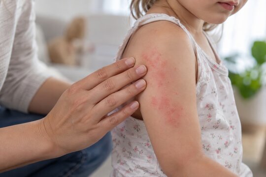Woman examining red allergy rash on shoulder of little girl. Child skin irritation and eczema symptoms on arm at home. Dermatology, pediatric health and skin disease concept.