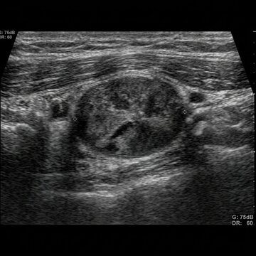 Detailed Ultrasound Scan Of A Suspicious Lesion Showing Complex Internal Structures