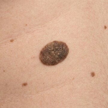Close-up Of A Brown Nevus On Human Skin With Fine Textures Detailed