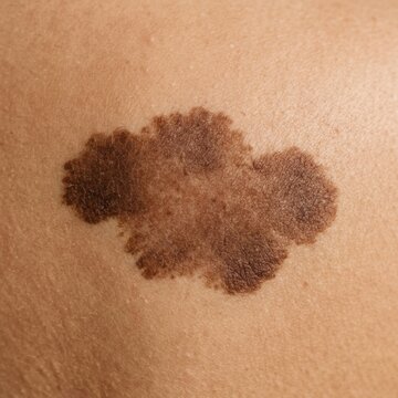 Detailed Close-Up Of A Melanoma Skin Lesion