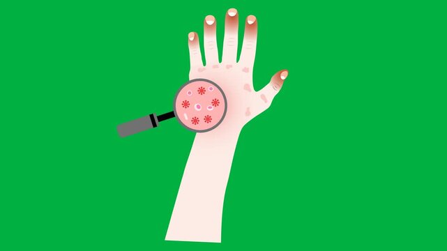 Medical vector animation showing human hand cyanosis and petechial skin rash alongside a magnifying view of bacterial pathogens in blood cells, highlighting sepsis, bacteremia, septic shock, toxemia, 