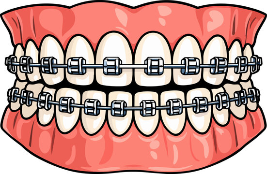 Full set of teeth with metal braces shown in an orthodontic illustration
