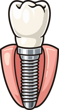 Single tooth with a dental implant and supporting gum structure