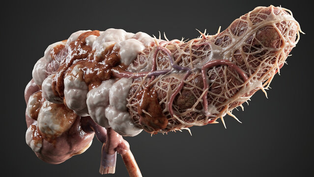 3D Medical Illustration of Pancreatic Cancer, Malignant Tumor Growth on Human Pancreas