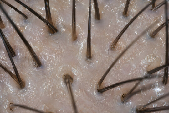 Thick hair shafts rooted in glossy scalp tissue captured with dermatoscopic magnification for clinical study