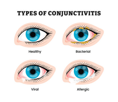 Different types of conjunctivitis labeled diagram, educational medical poster design healthcare scheme, healthy bacterial viral and allergic eye comparison. Labeled conjunctival redness and discharge