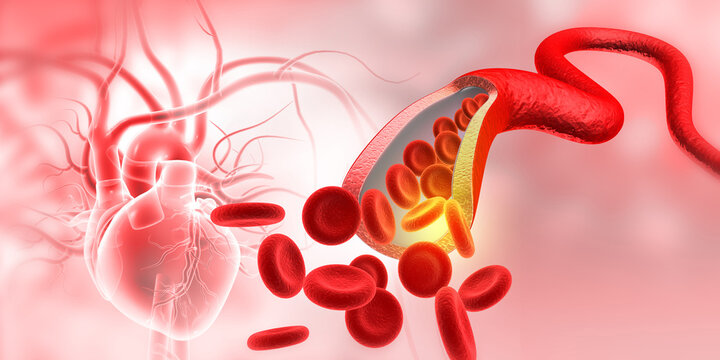 Human heart anatomy displaying a severely clogged artery with cholesterol plaque build-up