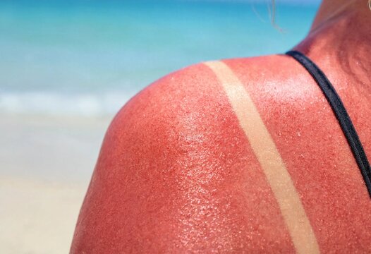 Severe Sunburn on Woman's Shoulder with Tan Line Showing Skin Damage from UV Exposure at the Beach