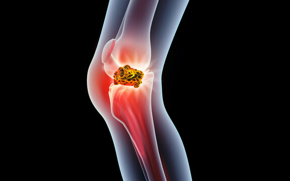 Detailed cross-section anatomy of a human knee joint showing a malignant tumor growth bone cancer on a medical scientific background.