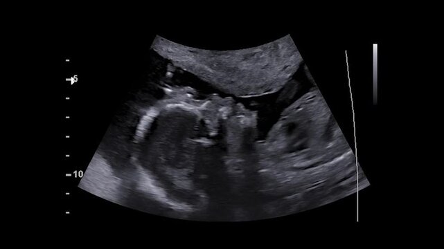 Sonogram of an unborn fetus around at around 20 weeks. Waving hello.
