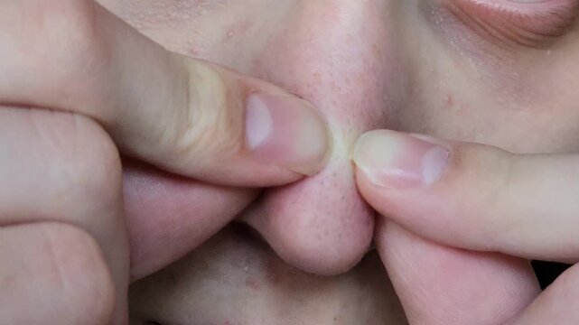 Person squeezing blackheads from nose pore skin