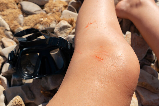 injured knee with minor cuts on human leg near diving mask on pebble beach background for designer template mockup concept of first aid, injury, accident, safety
