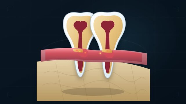 Professional dentist dental anatomy animation showing gum inflammation