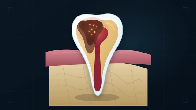 Dentist diagram showing stages of tooth decay and cavity progression