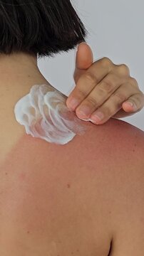 Applying lotion on sunburned skin for relief