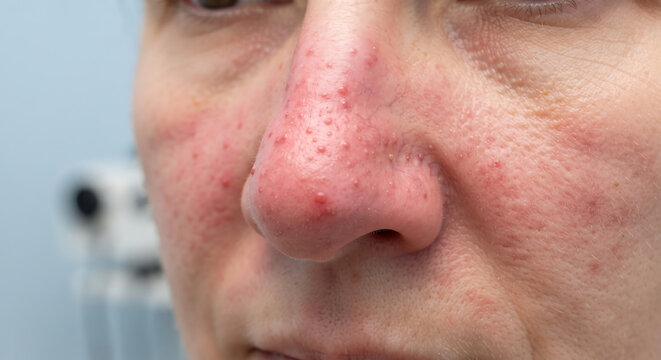 Close-up of a human face showing skin condition, with visible redness and bumps on the nose and cheek, highlighting a dermatological concern.