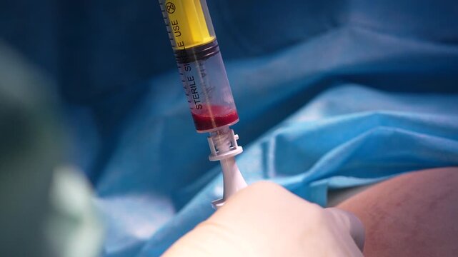Close-up of a medical professional's gloved hands using a syringe to extract red bone marrow from a patient during a sterile surgical procedure in an operating room environment