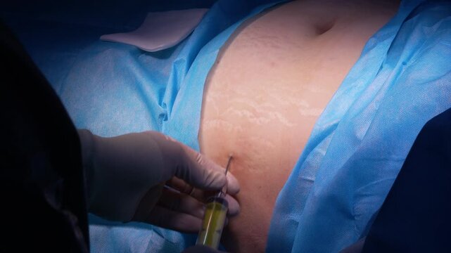 Plastic surgeon performing an abdominoplasty procedure by injecting tumescent fluid into the patient's belly, preparing the area for fat removal surgery in a modern aesthetic clinic