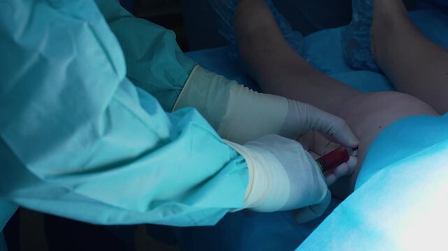 Medical doctor wearing sterile gloves performing a joint aspiration, draining fluid with a syringe from a patient's ankle during an orthopedic procedure in a hospital operating room