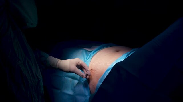 Skilled surgeon in a dark operating room carefully performing a liposuction procedure, injecting tumescent fluid into the patient's abdominal fat tissue with a cannula before fat removal