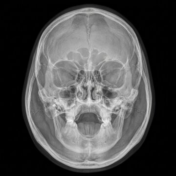Anatomical X-Ray Imaging Of Human Skull Medical Science And Healthcare Examination