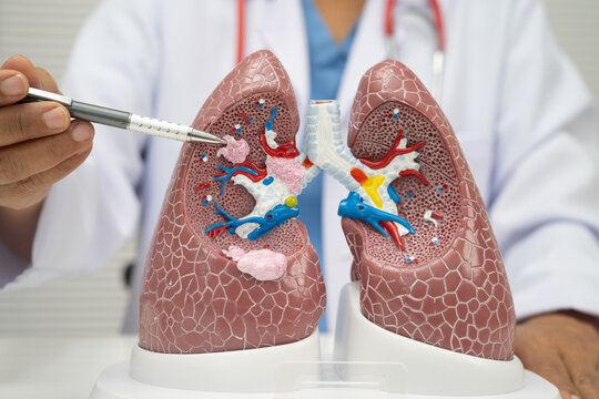 Pneumonia, lung cancer, Asian doctor with human lung model.