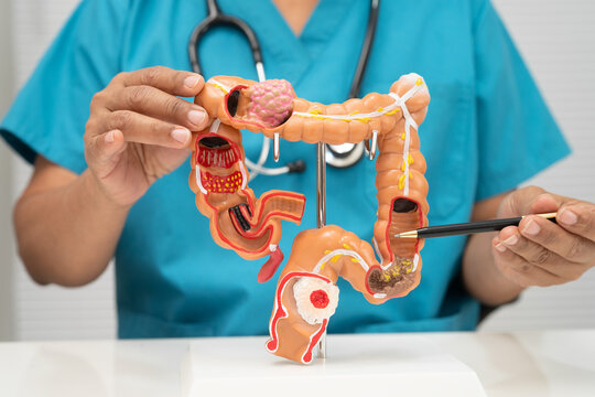 Colorectal cancer, doctor holding intestine colon human model.