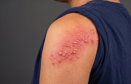 Close-up of a person's shoulder and arm displaying a painful blistering red rash, symptomatic of shingles or herpes zoster infection.