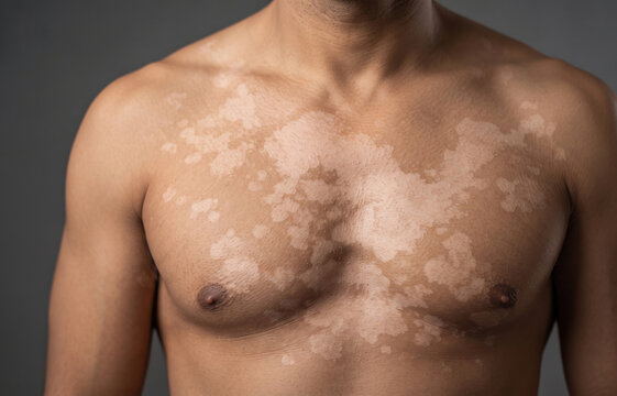 Close-up of a man's chest exhibiting vitiligo, showing patchy depigmentation and uneven skin tone on the torso.